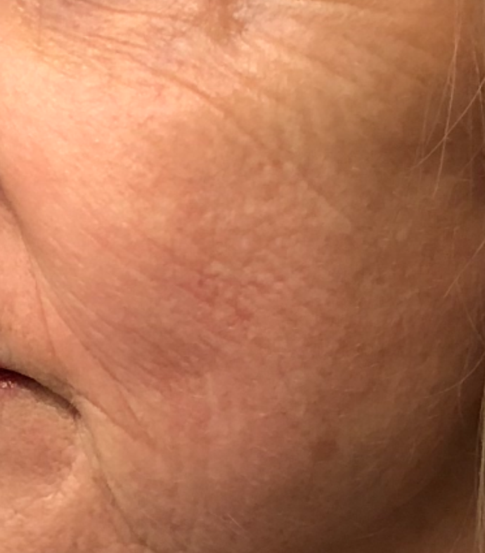4 weeks after 1 session of skin needling and PRP