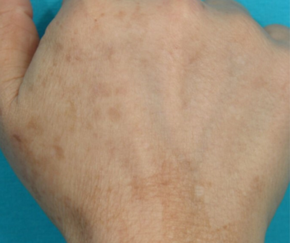 After laser pigmentation on back of hand