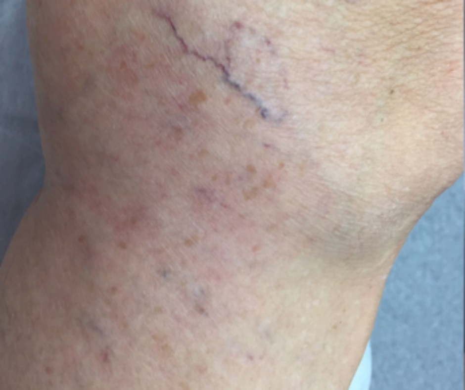 laser capillary reduction before