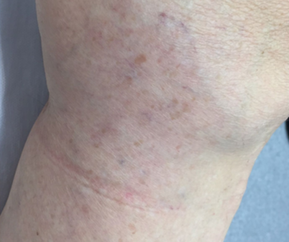 laser capillary reduction after