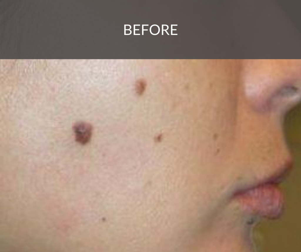 mole removal 7