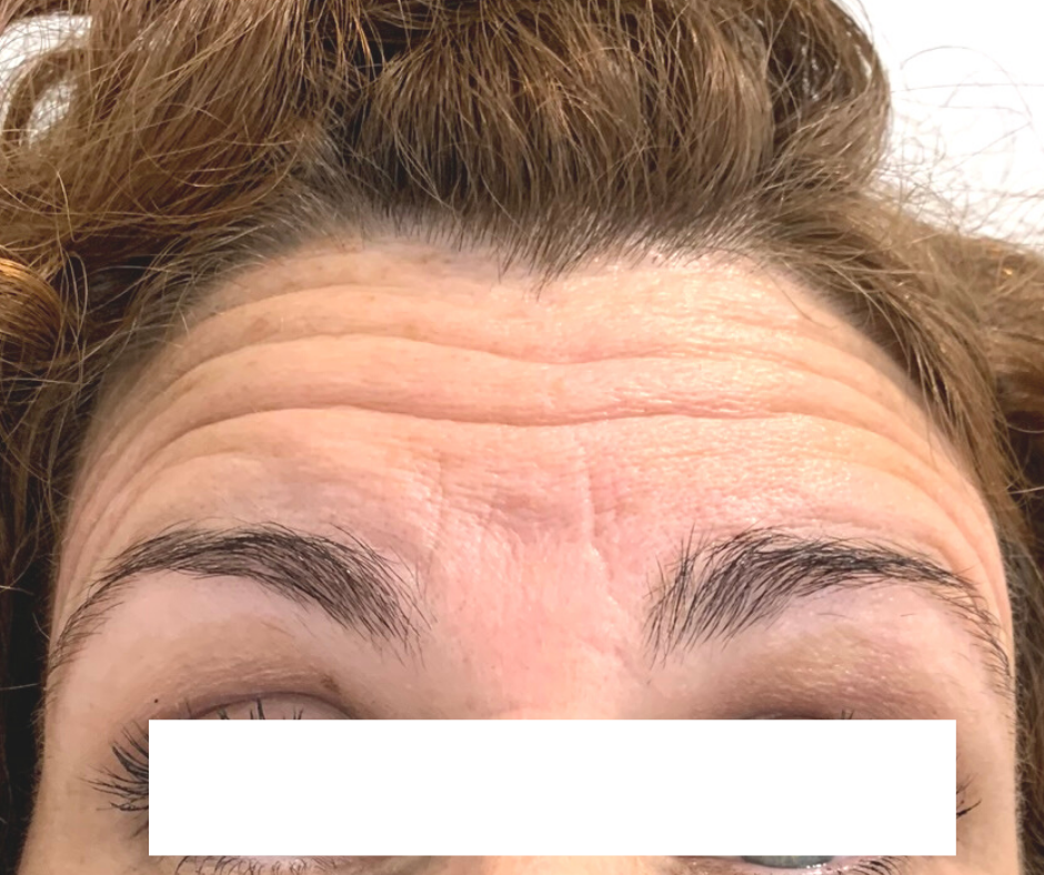 Anti Wrinkle Treatment Medwell Clinic Sunshine Coast