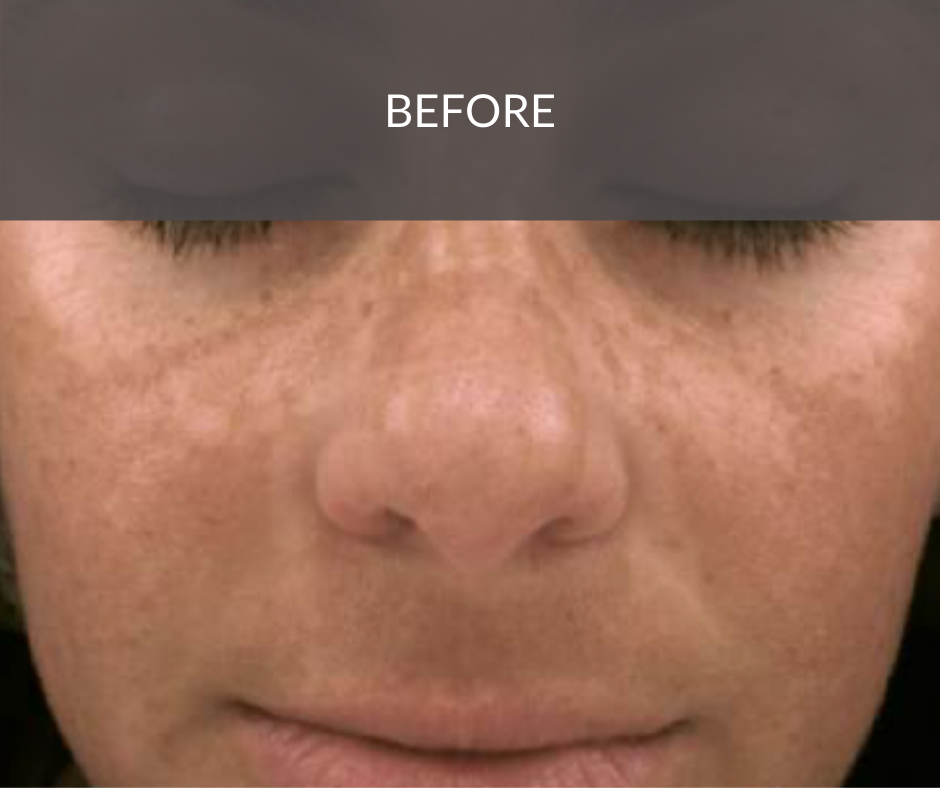 Pigmentation Reduction Peel Medwell Clinic Sunshine Co