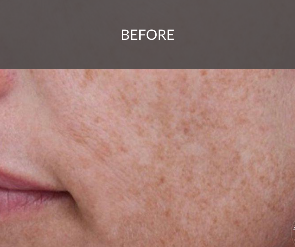 Pigmentation Reduction Peel Medwell Clinic Sunshine Co