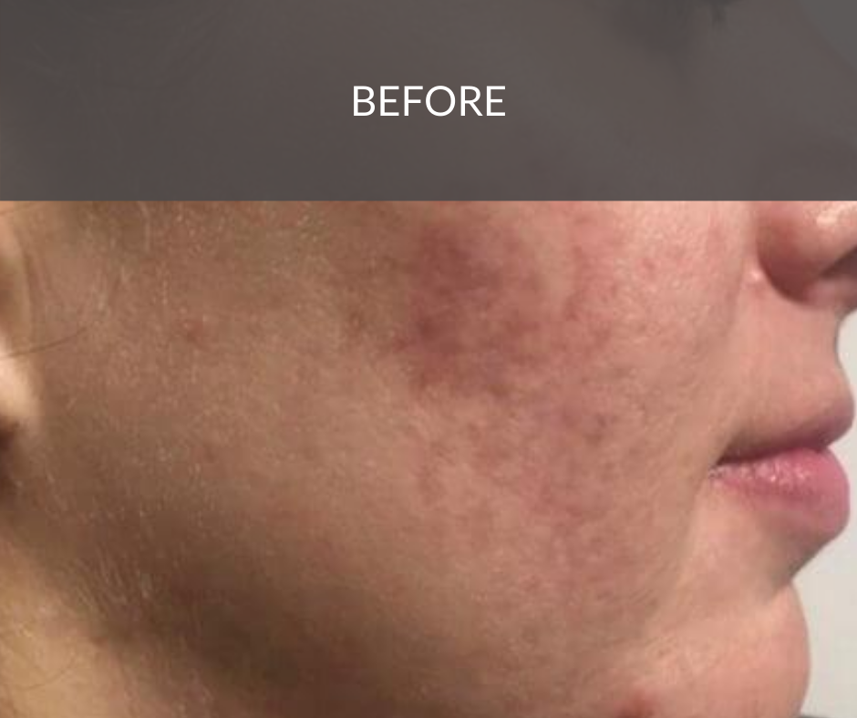 Pigmentation Reduction Peel Medwell Clinic Sunshine Co picture