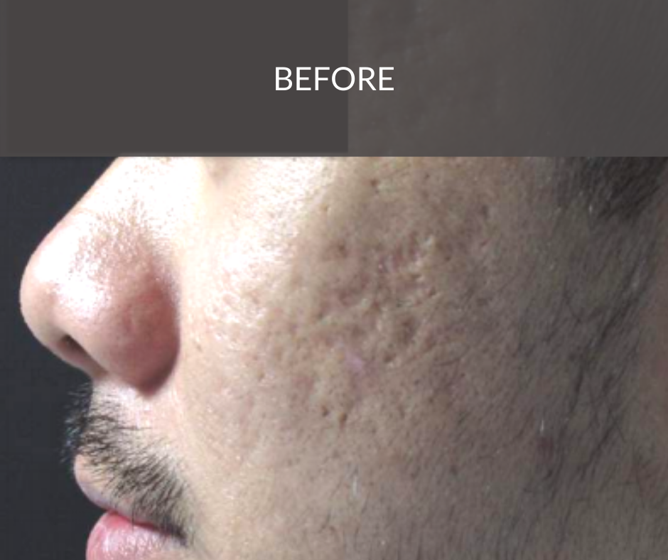 acne scar before